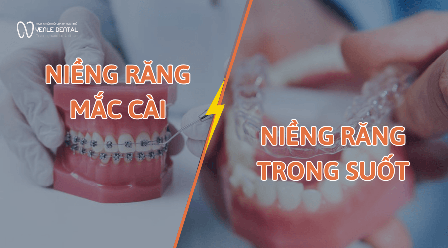 niềng răng mắc cài hay niềng răng trong suôt